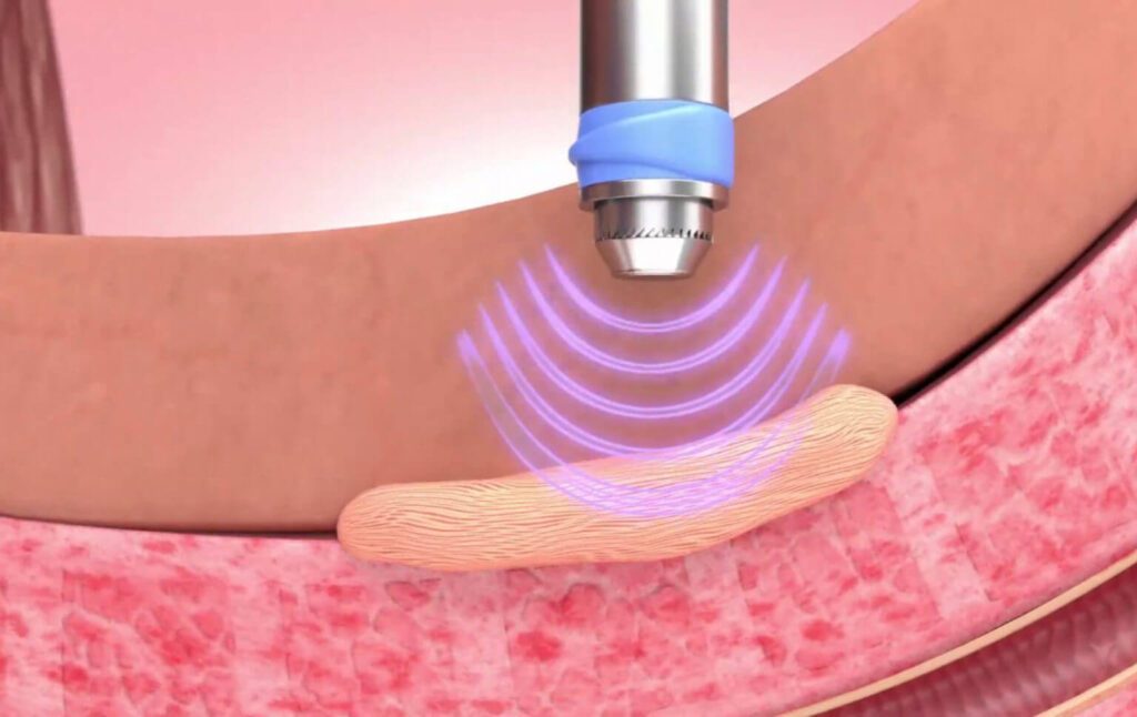 Shockwave Therapy For Peyronies Disease